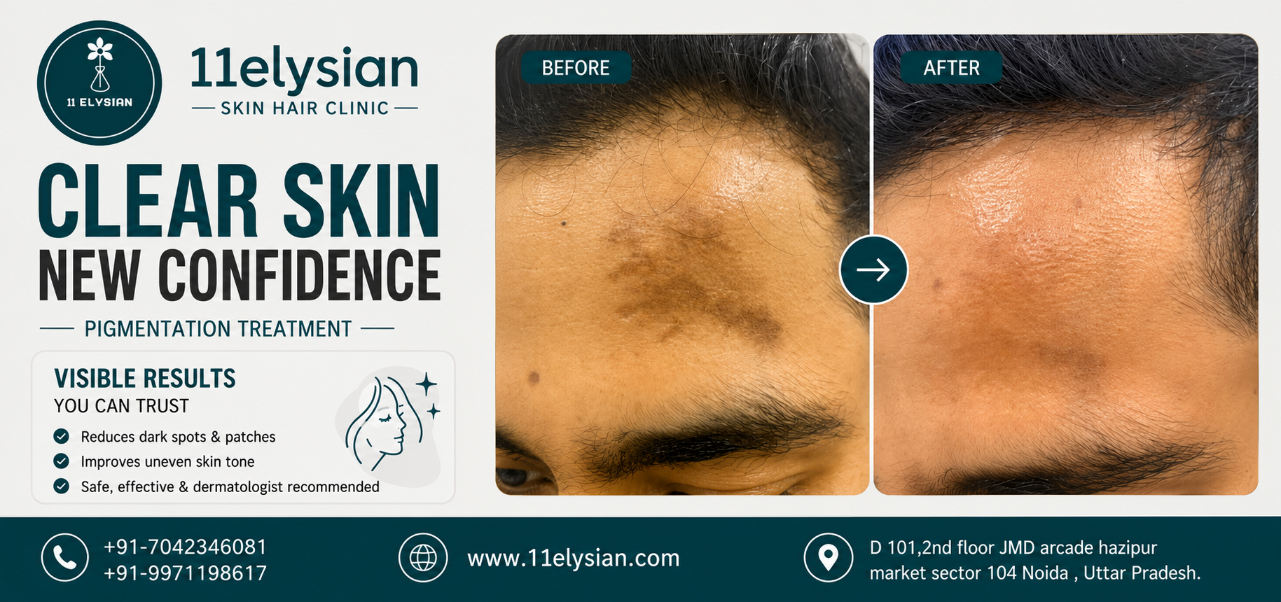 Pigmentation Treatment Near Sector 104, Noida